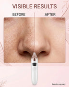Electric Blackhead Remover Vacuum – Rechargeable Pore Cleaner & Acne Extractor Device